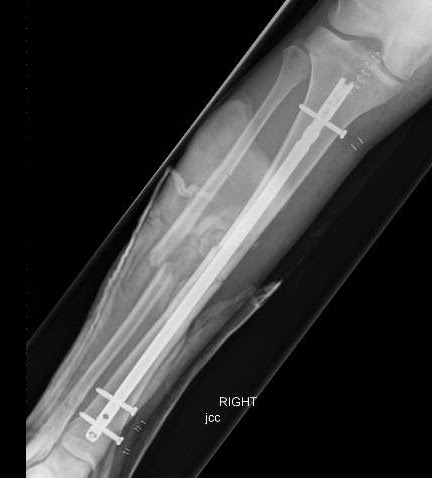 Paul george was taken off the court on a stretcher in 2014 after sustaining an open fracture of the tibia and fibula in his right leg during a game with the obviously it was a very gruesome injury, but the good thing is he's bounced back and he's better than ever, young said. Paul George S Tibia Fracture Shows The Rare But Serious Risks Of International Basketball Dr David Geier Sports Medicine Simplified