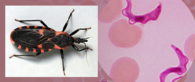 Chagas Disease