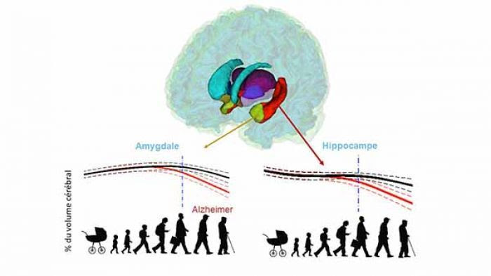 Atrophies cérébrales dans la maladie d'Alzheimer