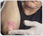 First-ever guidelines for pediatric psoriasis treatment released