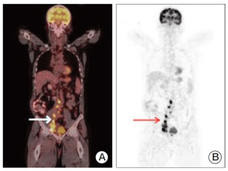 PET scans of patient torso