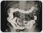 Fluoroscopy Procedure