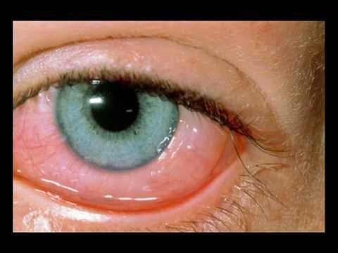Vernal Keratoconjunctivitis Uk - Resepi EE