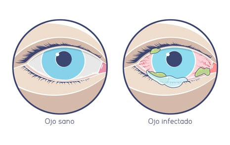 Imagen de un ojo sano y un ojo con conjuntivitis.