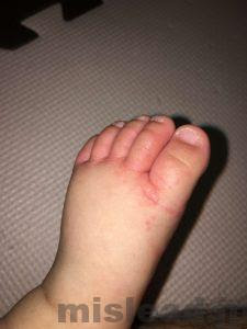 200以上 赤ちゃん 足の指の間 カサカサ 341151-赤ちゃん 足の指の間 カサカサ