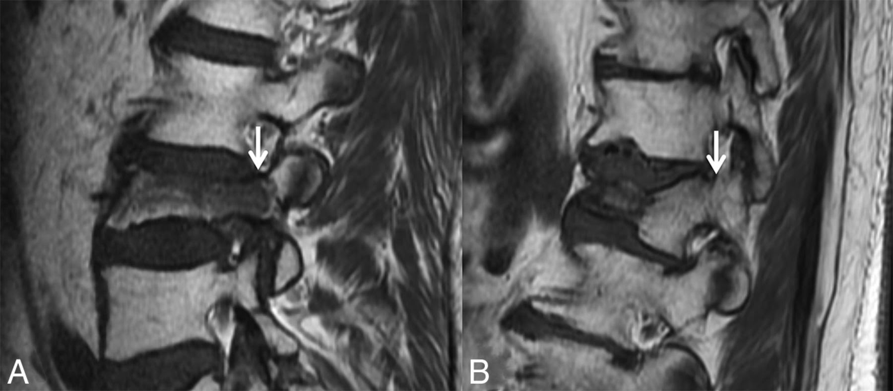 Mariam stepanyan, art director 27th december 2019. Review Of The Imaging Features Of Benign Osteoporotic And Malignant Vertebral Compression Fractures American Journal Of Neuroradiology
