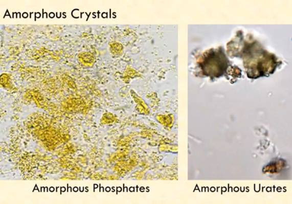 So in this article , we are going to see crystals present in acidic urine. Amorphous Crystals Medical Laboratories