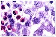 What is Langerhans Cell Histiocytosis?