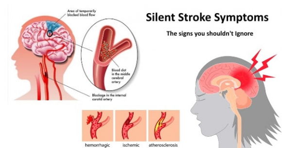 đột quỵ, dấu hiệu đột quỵ, 1 tháng trước khi đột quỵ, dấu hiệu cơ thể cảnh báo đột quỵ