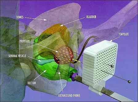 The terms brachytherapy or internal radiation therapy might also be used to describe this procedure. Prostate Seed Information