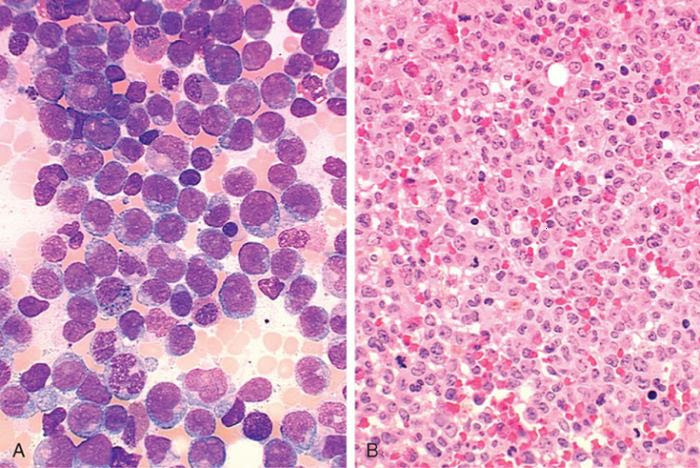 La leucemia mieloide cronica si verifica quando una cellula staminale pluripotente va incontro a trasformazione maligna e mieloproliferazione clonale, portando a una marcata iperproduzione di. Leucemia Mieloide Cronica Lmc Especial Cancer