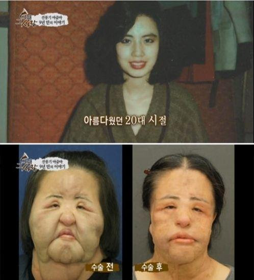 50 韓国 整形 失敗 画像 整形 失敗 画像 韓国 Lorinahuston