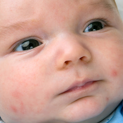 Acne Neonatal: três dados que você precisa saber sobre espinhas em bebê saúde do bebê acne no bebê acne neonatal 