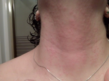 Heat rash - Symptoms and causes - Mayo Clinic