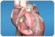 Glenfield Hospital first in the UK and Ireland to implant world’s smallest, wireless pacemaker