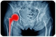 6 out of 10 hip replacements last 25 years or longer, according to a new study
