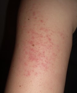 Det kan orsaka allvarliga skador på kroppens. Keratosis Pilaris Information Och Behandling