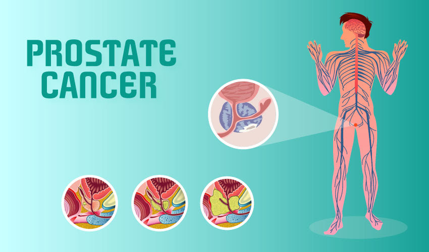 Despite this, pancreatic cancer is among the deadliest types of cancer, which is why it's extremely important to know and recogni. Basics Of Prostate Cancer With Symptoms And Prevention