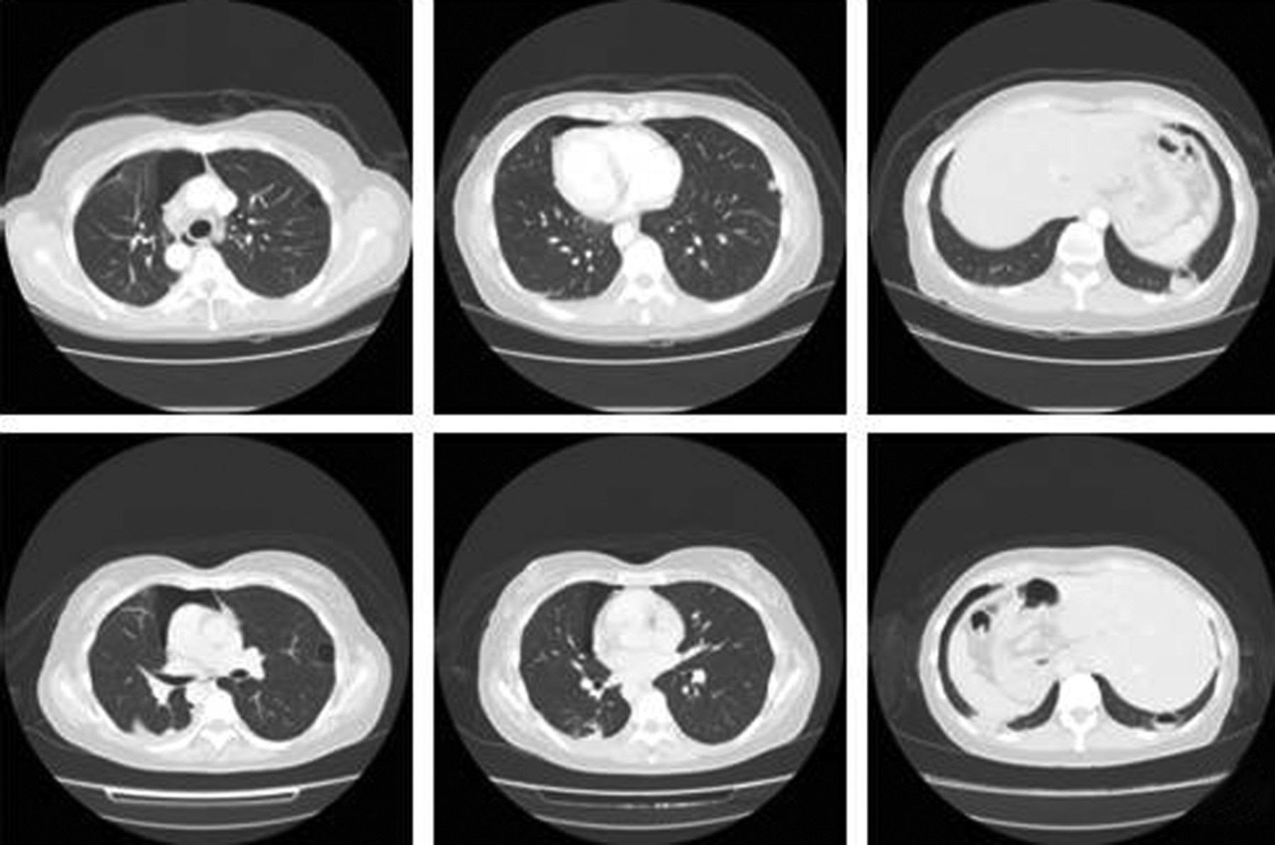 However, since ct scans require more radiation than other types of imaging exams, rmi is committed to managing radiation dose for patient safety, under the principles of the image gently program for pediatric patients and the image wisely program for adults. Catamenial Pneumothorax Due To Bilateral Pulmonary Endometriosis Respiratory Care