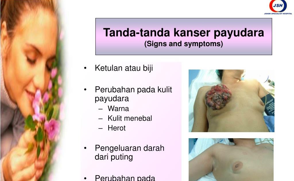 tanda tanda kanser perut