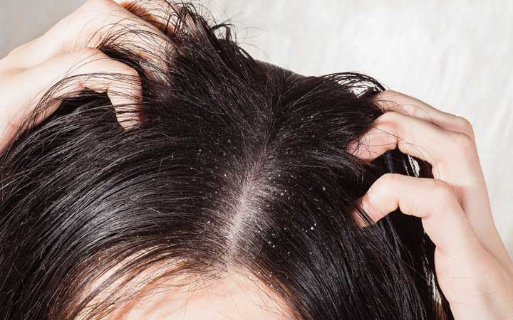 Ringworm is highly contagious but, fortunately, it has nothing to do with drying your baby's hair after a bath is based on personal preference. The Truth About Anti Dandruff Hair Oils Skinkraft