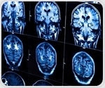 Monthly cycles of brain activity linked to seizures in patients with epilepsy