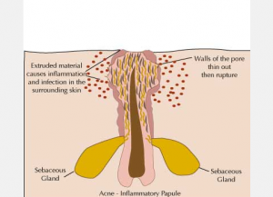 chunusi papule