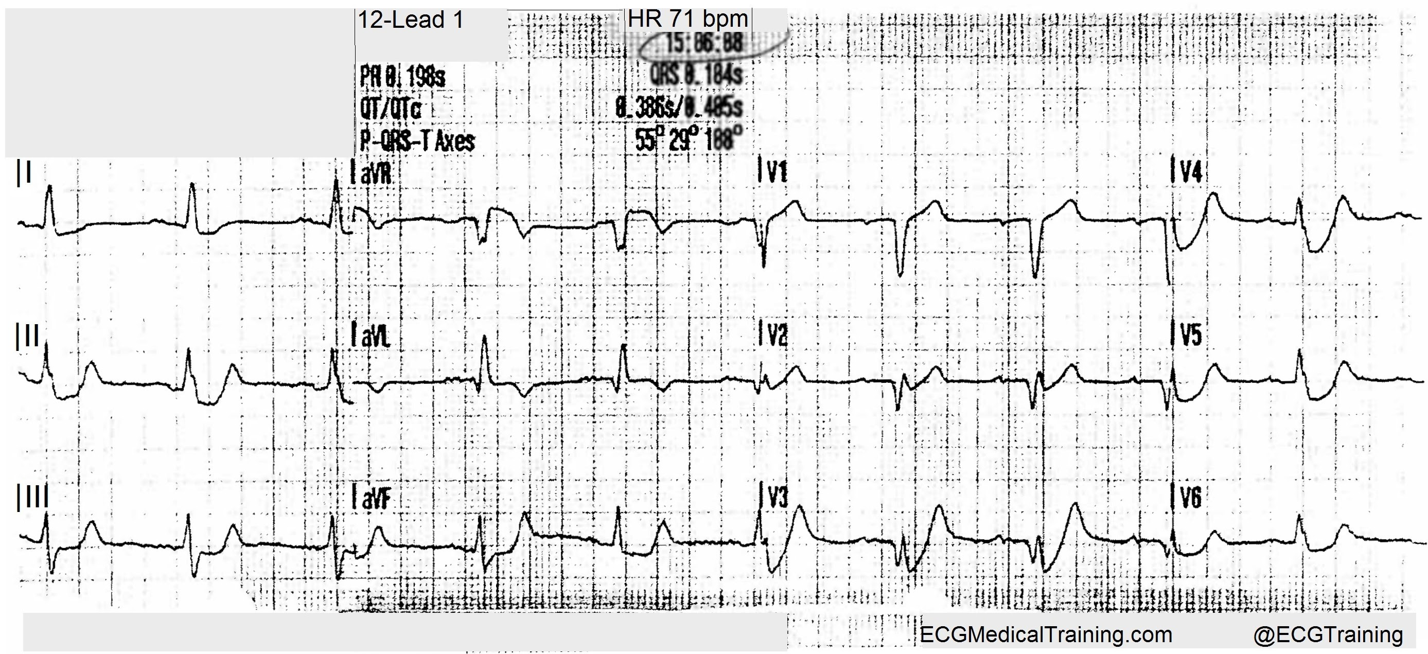 A service of the national library of medicine, national institutes of health. De Winter St T Waves Ecg Medical Training