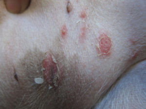Impetigo is a bacterial infection of the skin that is more common in young children than other ages. Impetigo In Dogs