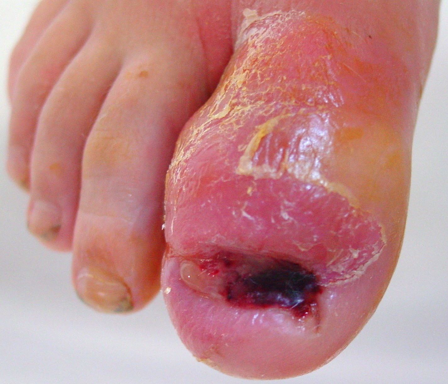 Toenail infections pictures - Awesome Nail