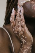 Doença é caracterizada por manchas brancas devido à ausência ou diminuição do pigmento natural da pele, a melanina