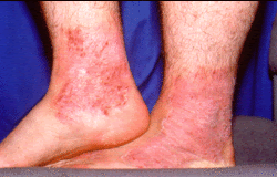 Atopic dermatitis