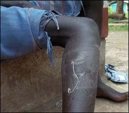 The figure above is a photograph showing a person’s leg infected with dracunculiasis.