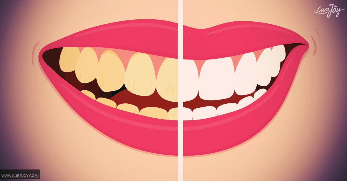 7 Natural Teeth Whitening Home Remedies For A Beautiful Smile