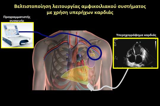3 559 просмотров 3,5 тыс. Amfikoiliakh Bhmatodothsh Apinidwths Heart Rhythm Center
