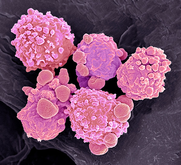 Coloured scanning electron micrograph (SEM) of blood cells from chronic lymphocytic leukaemia