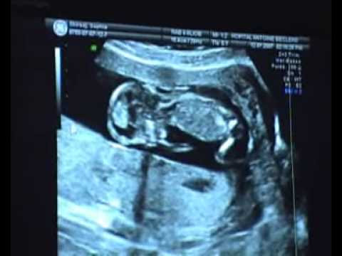 Colique Nephretique Foetus 6 Semaines