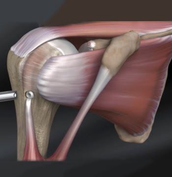 Muscles move the bones by pulling on the tendons. Biceps Tendon Ohio Shoulder Center