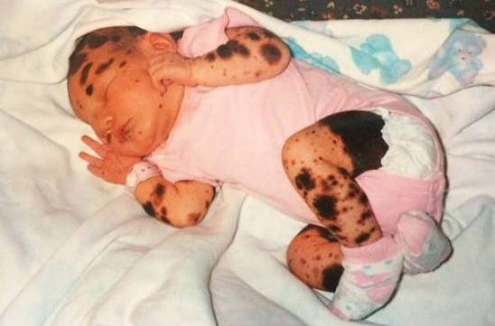 Ciera Swaringens ainda bebê com suas pintas, que são sua identidade, afinal nasceram com ela
