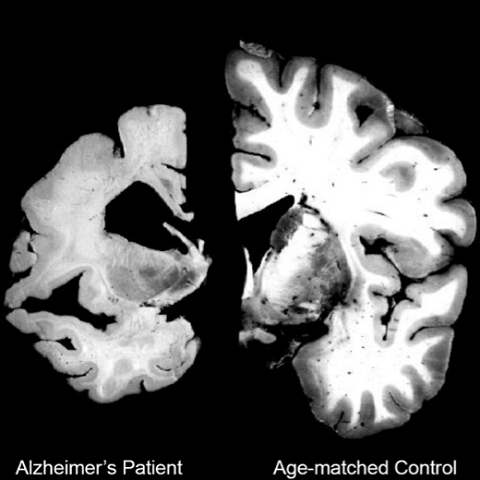 Alzheimer's Annotated Paper