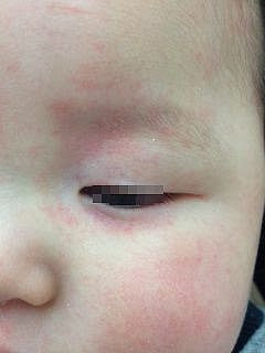 トップ100 子供 目の周り 赤い アレルギー かわいい子供たちの画像