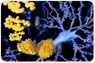 Alzheimer's disease: high amyloid levels linked to early disease