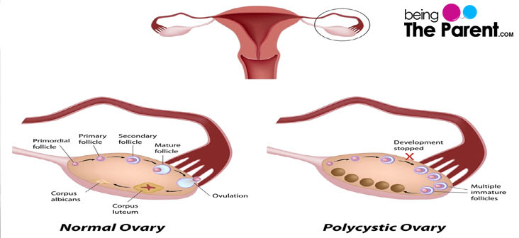 How to tell if you have an ovarian cyst