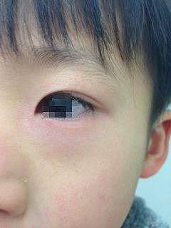元の子供 目の周り 赤い ぶつぶつ かわいい子供たちの画像