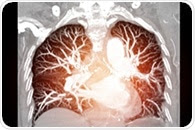 World Lung Cancer Day: FIRS commemorates and supports lung cancer patients