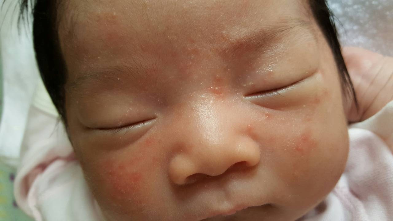 赤ちゃん お腹 プツプツ 赤ちゃん お腹 プツプツ