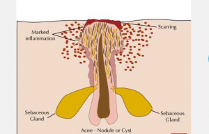 chunusi nodules