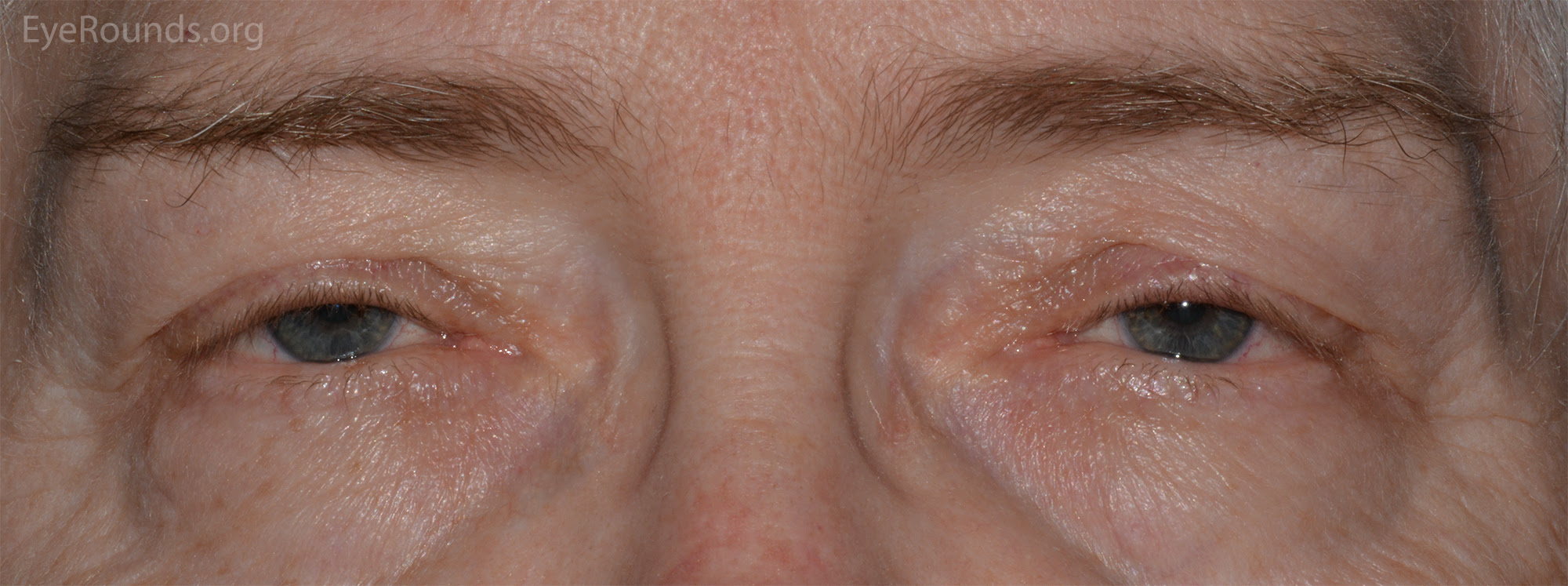 Maybe you would like to learn more about one of these? A Primer On Ptosis