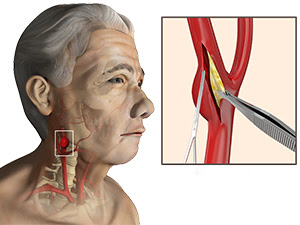 When these arteries become narrowed, it's called carotid artery disease. Carotid Artery Disease Treatment Sydney Cad Sydney