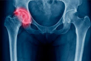 Fractura de cadera, consejos para recuperarse